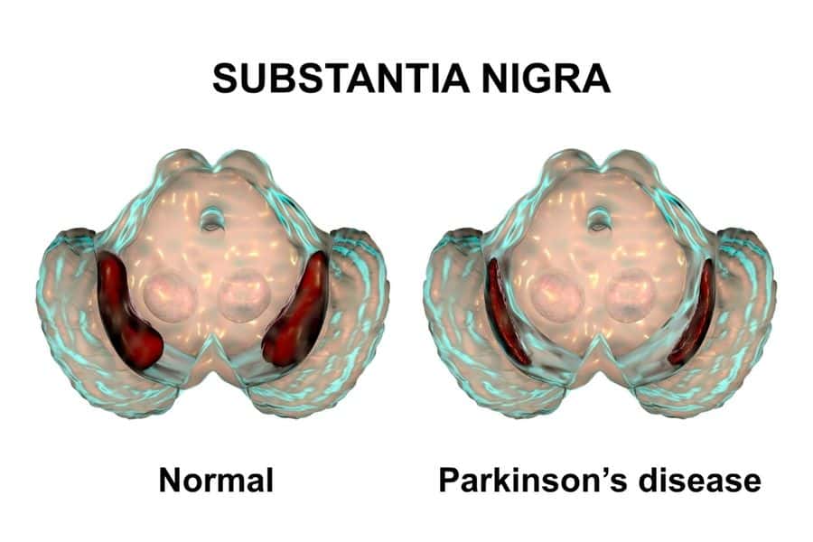 La enfermedad de Parkinson se caracteriza por la muerte prematura de neuronas dopaminérgicas en la pars compacta.