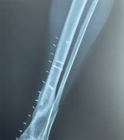 "Fases de la consolidación de una fractura: hematoma, callo blando, callo duro y remodelación".
